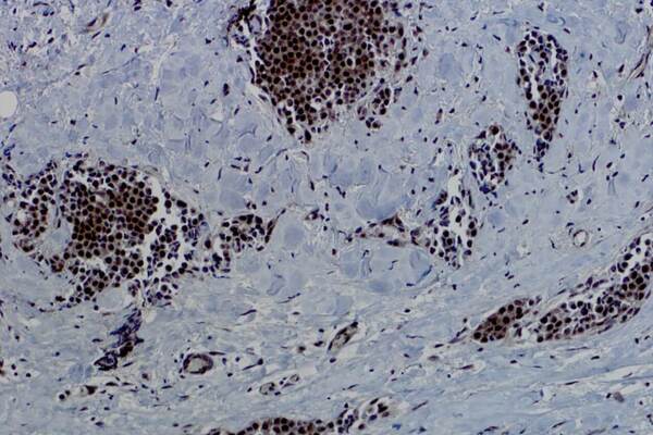 Invasive lobular mammary carcinoma immuno-stained for NOTCH4.  The NOTCH4 gene was one of 11 genes that were more frequently mutated in breast cancers from Native American women. Image shows nuclear localization of NOTCH4 (brown stain), indicative of active Notch signaling.  The Notch signaling pathway is associated with maintenance of cancer stem cells that can lead to therapy resistance and disease recurrence.